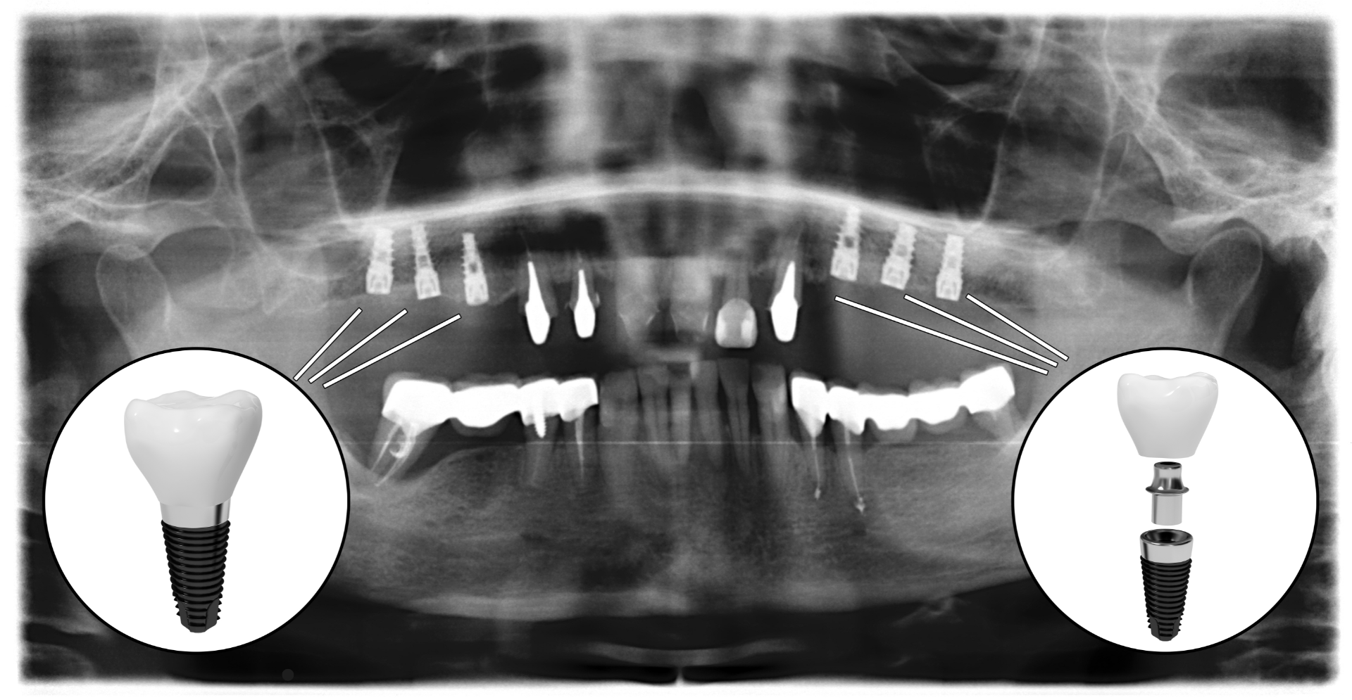 X-ray image showing dental implants securely placed in the upper jaw, illustrating successful integration and alignment for optimal oral health restoration.