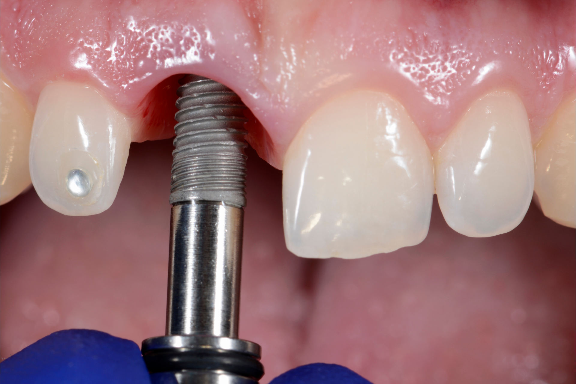 Close-up view of a dental implant being carefully placed into the jawbone, illustrating the precision and expertise involved in modern implant dentistry