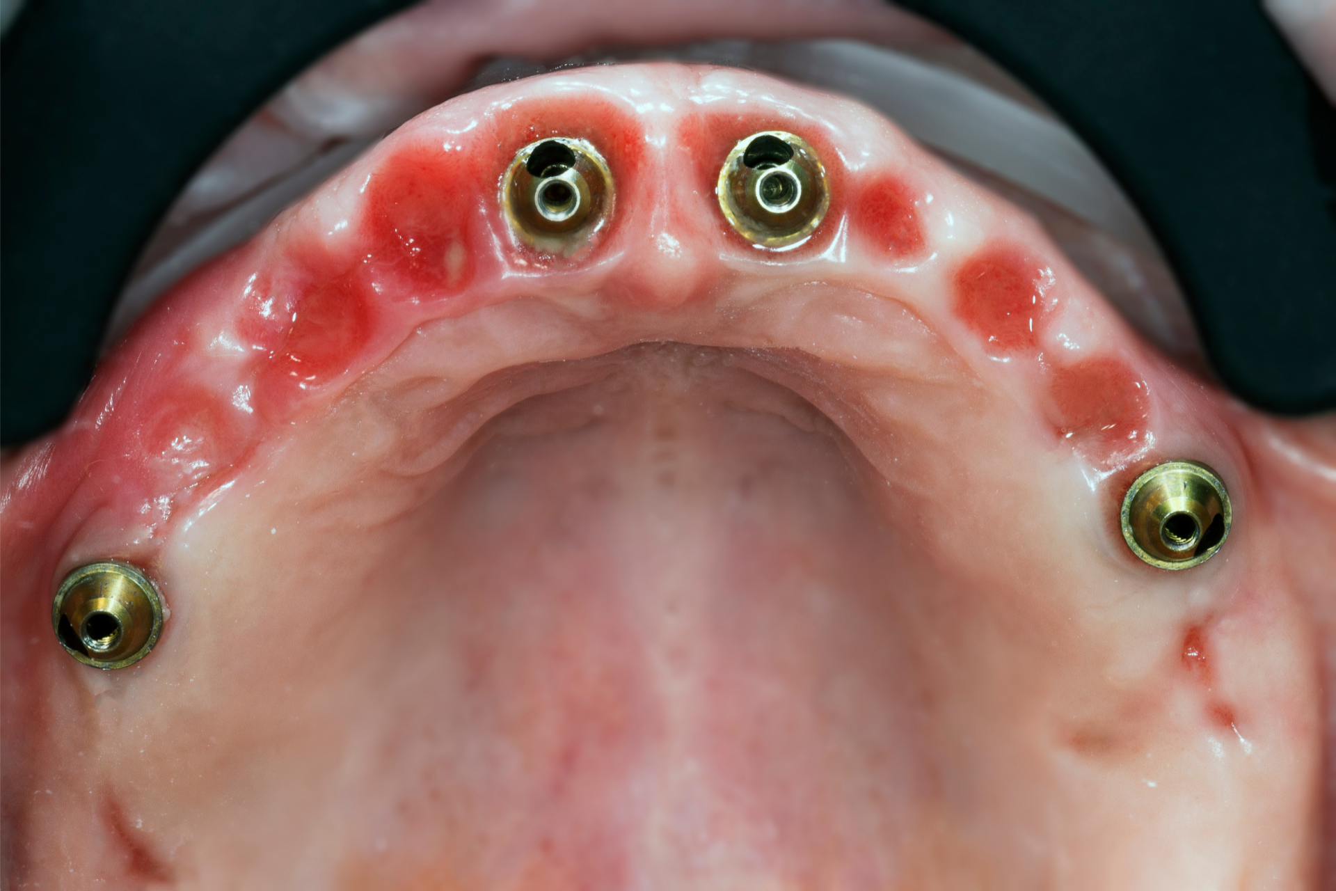 Close-up of All-on-Four dental implant screws securely placed in the upper jaw, ready for the attachment of a custom full-arch prosthetic at Smile Perfection in Livingston, NJ.