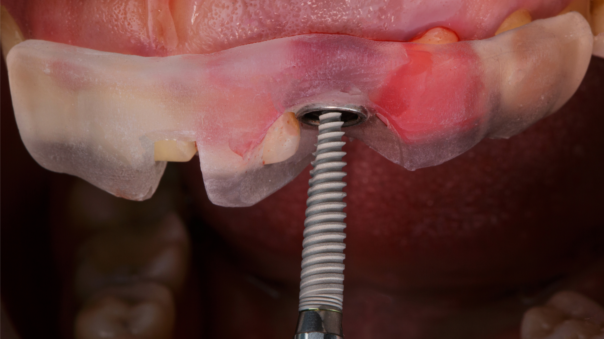 Close-up image of the dental implant placement process, showing a titanium implant being carefully inserted into the jawbone