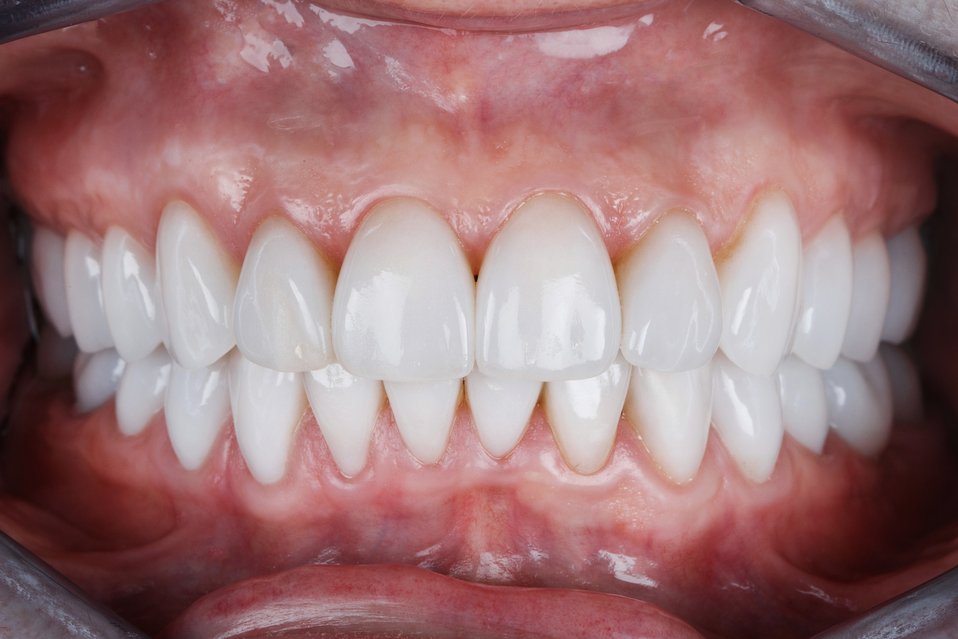 A close-up view of a bright, symmetrical smile after cosmetic dental treatment, showcasing perfectly aligned and natural-looking teeth.